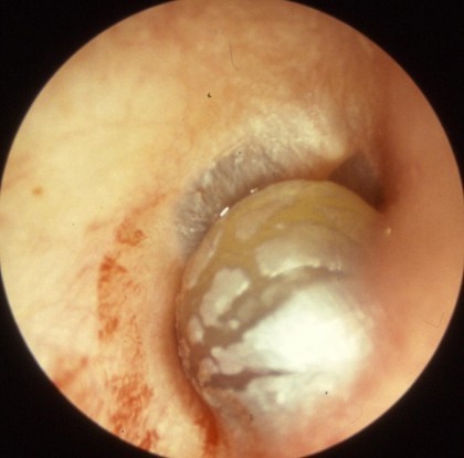 Grippeotitis