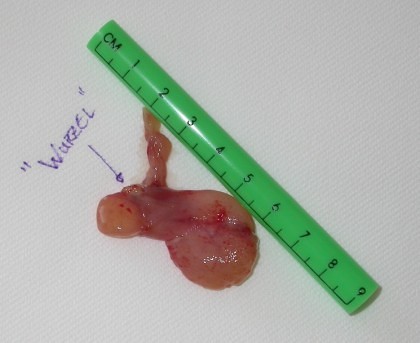 grosser Nasenpolyp