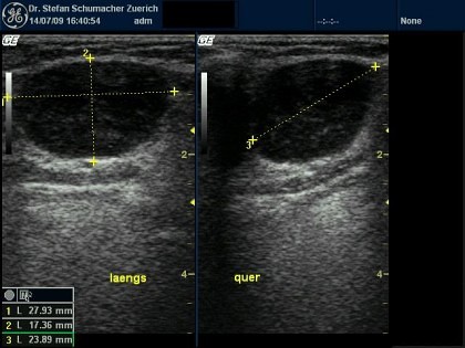 Lymphom