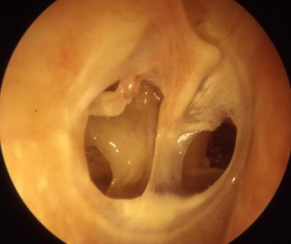 Trommelfelldefekte bei chronischer Mittelohrentzündung